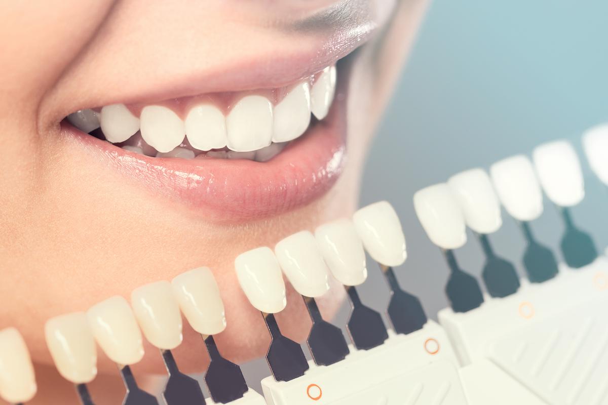 Matching the shades of the implants or the process of teeth whitening.